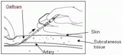 QuickSeal Arterial Closure System